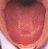 Diagnóstico por la lengua temblorosa. MTC